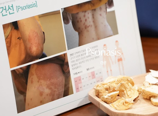 생기한의원이 정리한 건선 증상 관찰 시 확인하면 좋은 기본 정보